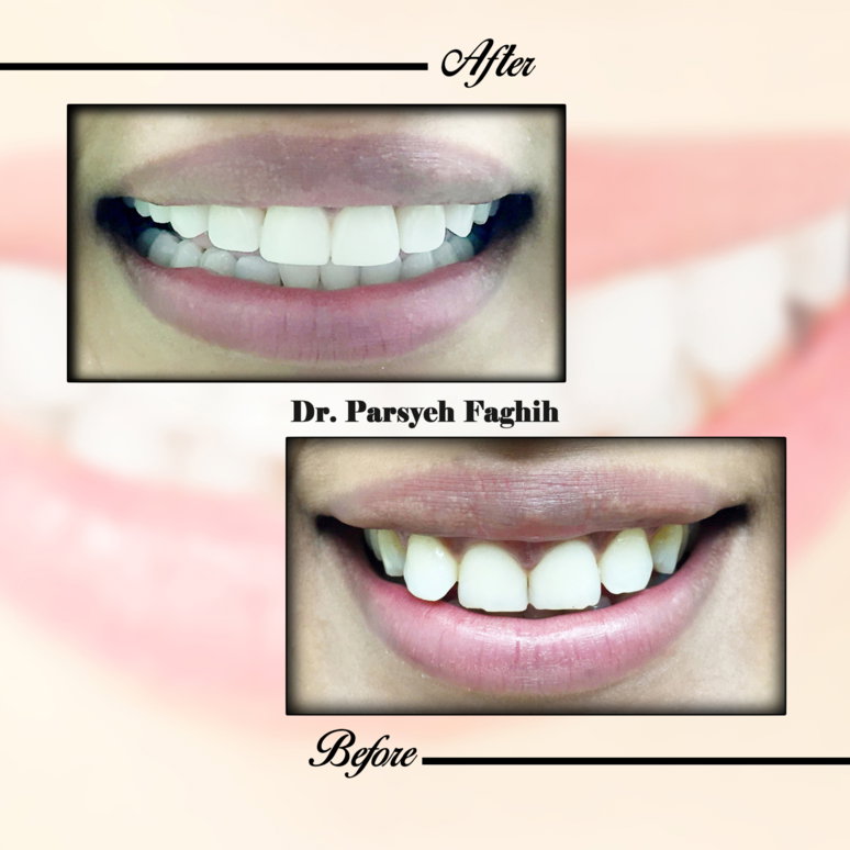 Cosmetic smile makeover — straighter, brighter, natural.