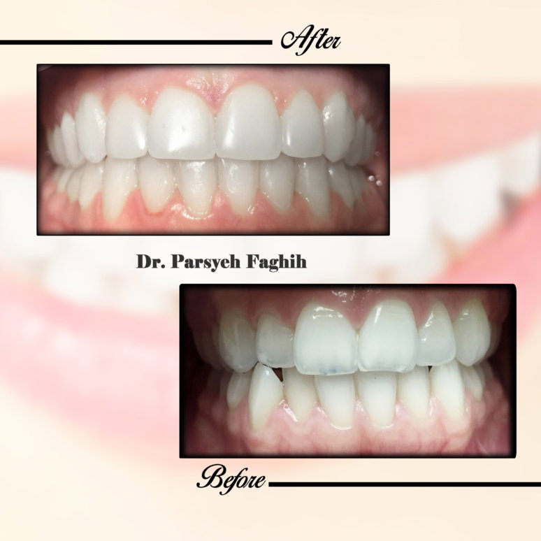 Full smile restoration — even, healthy and confident.